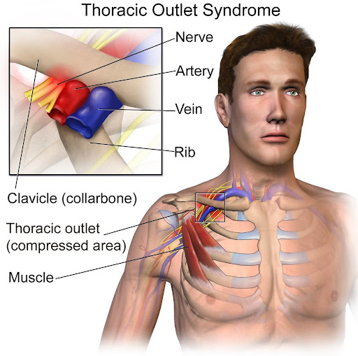 Thoracic Outlet Syndrome